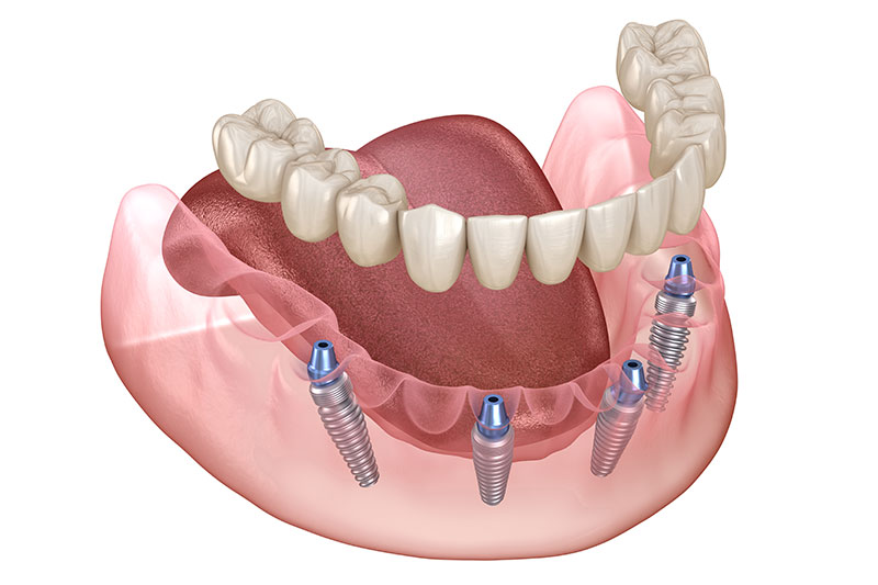 All on 4 Dental Implants in Phoenix